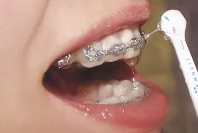 Для чого потрібен іригатор обов'язково його застосування (іригатор) Для чого потрібен іригатор обов'язково його застосування