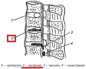 Дорзальная екструзія, лікування та діагностування