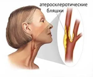 Дуплексне сканування судин голови та шиї (голови) Дуплексне сканування судин голови та шиї