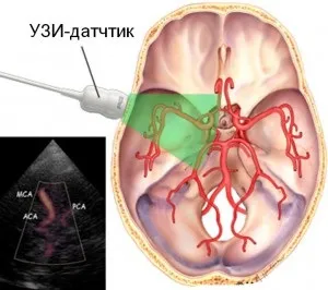 Дуплексне сканування судин голови та шиї (голови) Дуплексне сканування судин голови та шиї
