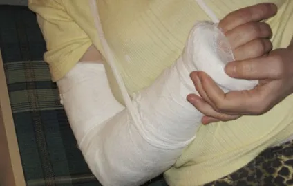 Чи повинна боліти рука, нога в гіпсі (нога) Чи повинна боліти рука, нога в гіпсі