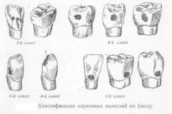 Карієс зубів причини, симптоми і класифікація (карієс) Карієс зубів причини, симптоми і класифікація