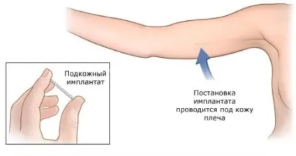 Капсула протизаплідна - підшкірна контрацепція в ампулах (підшкірна) Капсула протизаплідна - підшкірна контрацепція в ампулах