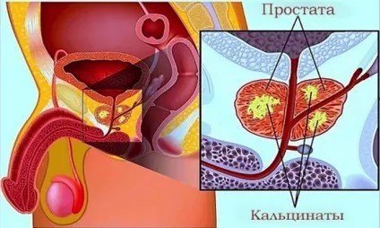 Кальцинати в передміхуровій залозі - вирок або тимчасове утруднення (кальцинати) Кальцинати в передміхуровій залозі - вирок або тимчасове утруднення