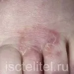 Ефективне лікування екземи