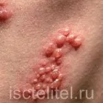 Ефективне лікування екземи