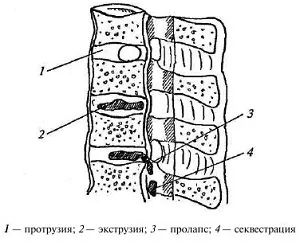Екструзія міжхребцевих дисків що це таке, яке лікування захворювання (екструзія) Екструзія міжхребцевих дисків що це таке, яке лікування захворювання