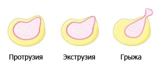Екструзія міжхребцевого диска, що це таке