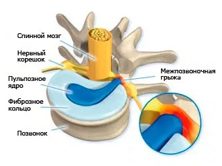 Екструзія міжхребцевого диска, що це таке