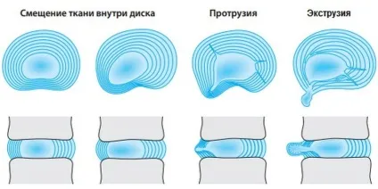 Екструзія дисків хребта, що це таке, діагностика лікування (екструзія дисків хребта що це таке грудного шийного поперекового відділу види як ніж операція при лікування діагностика) Екструзія дисків хребта, що це таке, діагностика лікування