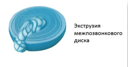 Екструзія міжхребцевих дисків що це таке, яке лікування захворювання (лікування) Екструзія міжхребцевих дисків що це таке, яке лікування захворювання