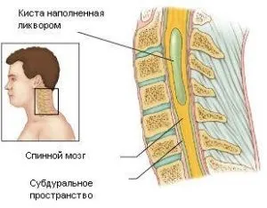 Гідроміелія шийного, грудного, поперекового відділу хребта сіптоми, лікування (гідроміелія) Гідроміелія шийного, грудного, поперекового відділу хребта сіптоми, лікування