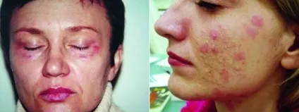 Гіалуронова кислота що це таке і як застосовується в косметології відгуки (кислота) Гіалуронова кислота що це таке і як застосовується в косметології відгуки