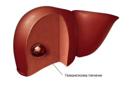 Гемангіома печінки - форми, причини, симптоми, лікування