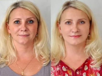Гіалуронова кислота що це таке і як застосовується в косметології відгуки (косметології) Гіалуронова кислота що це таке і як застосовується в косметології відгуки