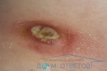 Гнійні ускладнення післяопераційних ран - відповіді і поради на твої питання (гнійні) Гнійні ускладнення післяопераційних ран - відповіді і поради на твої питання