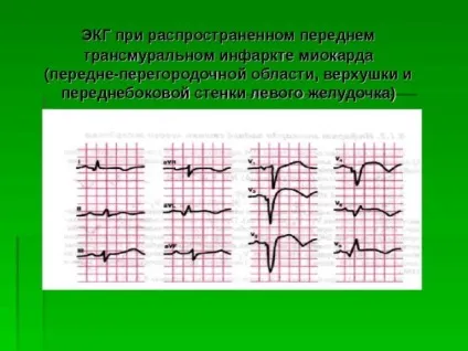 Інфаркт трансмуральний симптоми і причини, прояв на ЕКГ, ЛФК, прогноз