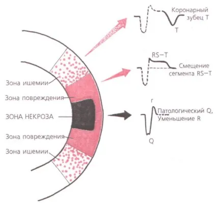 Інфаркт трансмуральний симптоми, прояв на ЕКГ, види і причини (види) Інфаркт трансмуральний симптоми, прояв на ЕКГ, види і причини