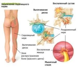 Ішіас симптоми і лікування в домашніх умовах (грижі міжхребцевого диска) Ішіас симптоми і лікування в домашніх умовах