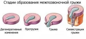 Як лікувати протрузию міжхребцевих дисків