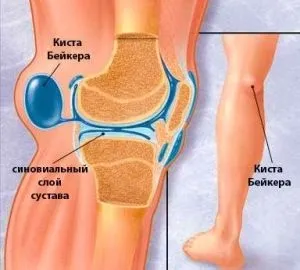 Кіста Бейкера колінного суглоба причини, симптоми, лікування