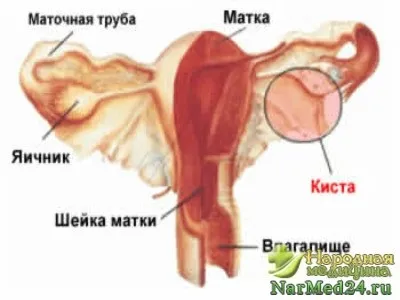 Кіста яєчника симптоми захворювання, методи лікування, важливість профілактики