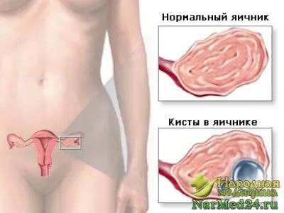 Кіста яєчника симптоми захворювання, методи лікування, важливість профілактики