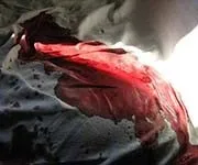 Як відмити марганцівку з шкіри і рук (відмити марганцівку шкіри) Як відмити марганцівку з шкіри і рук