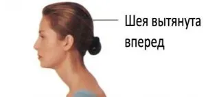 Як перемогти синдром «комп'ютерної шиї»