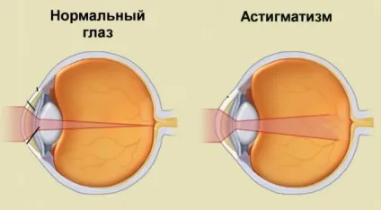 Як бачить людина з астигматизмом, зір при астигматизмі (бачить) Як бачить людина з астигматизмом, зір при астигматизмі