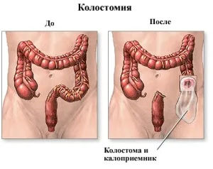 Колостома це вирок або шлях до якісного життя (життя) Колостома це вирок або шлях до якісного життя