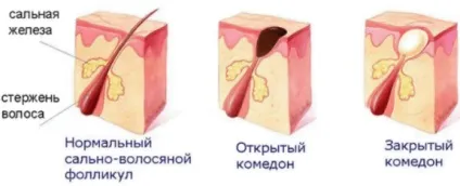 Комедони на обличчі як позбутися в домашніх умовах (умовах) Комедони на обличчі як позбутися в домашніх умовах
