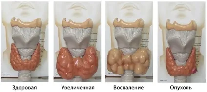 Колоїдний зоб щитовидної залози з кістозної дегенерацією - що це таке (щитовидної) Колоїдний зоб щитовидної залози з кістозної дегенерацією - що це таке