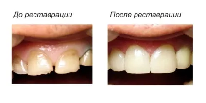 Косметична реставрація зубів - методи відновлення передніх і задніх зубів, вартість (зубів) Косметична реставрація зубів - методи відновлення передніх і задніх зубів, вартість