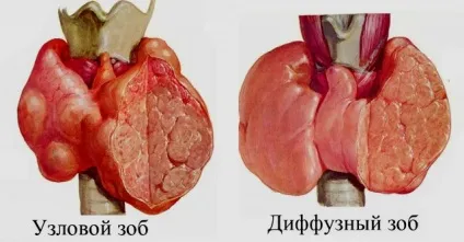 Колоїдний зоб щитовидної залози з кістозної дегенерацією - що це таке (залози) Колоїдний зоб щитовидної залози з кістозної дегенерацією - що це таке