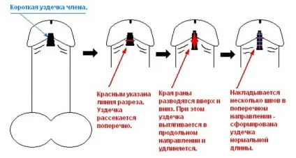 Коротка вуздечка крайньої плоті статевого члена у дорослих чоловіків і новонародженого методи лікування (плоті) Коротка вуздечка крайньої плоті статевого члена у дорослих чоловіків і новонародженого методи лікування