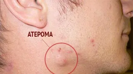 Кома після інсульту в яких випадках відбувається, прогнози розвитку ситуації (інсульту) Кома після інсульту в яких випадках відбувається, прогнози розвитку ситуації