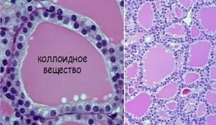 Колоїдний зоб щитовидної залози з кістозної дегенерацією - що це таке (залози) Колоїдний зоб щитовидної залози з кістозної дегенерацією - що це таке