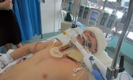 Кома після інсульту в яких випадках відбувається, прогнози розвитку ситуації (інсульту) Кома після інсульту в яких випадках відбувається, прогнози розвитку ситуації