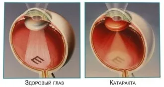 Катаракта при цукровому діабеті операція профілактика, норми (діабеті) Катаракта при цукровому діабеті операція профілактика, норми