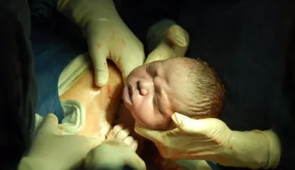Кесарів розтин можливі ризики операції - пологи - babygreen, природний підхід - здорова дитина (ризики) Кесарів розтин можливі ризики операції - пологи - babygreen, природний підхід - здорова дитина