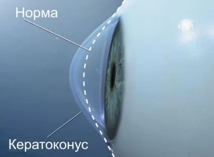 Кератоконус очі що це таке, симптоми, профілактика та лікування (очі) Кератоконус очі що це таке, симптоми, профілактика та лікування