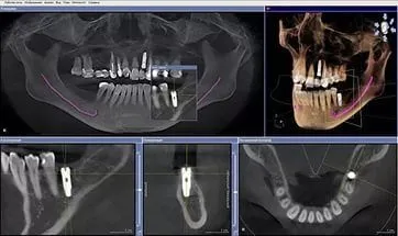 Комп'ютерна томографія зубів і щелепи, що таке 3d-томографія (зубів) Комп'ютерна томографія зубів і щелепи, що таке 3d-томографія