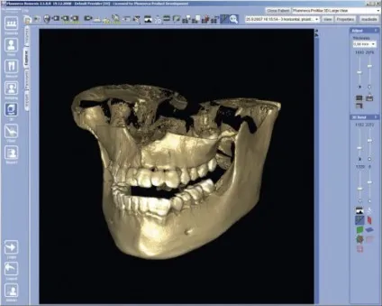 Комп'ютерна томографія зубів і щелепи, що таке 3d-томографія (комп'ютерна) Комп'ютерна томографія зубів і щелепи, що таке 3d-томографія