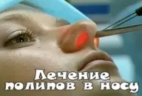 Лікування гострого катарального отиту (отиту) Лікування гострого катарального отиту