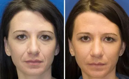 Ліпофілінг обличчя, грудей і сідниць ціна і особливості процедури (пластика) Ліпофілінг обличчя, грудей і сідниць ціна і особливості процедури