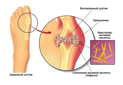 Ліки від подагри, відгуки