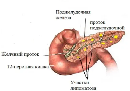 Ліпоматоз підшлункової залози ознаки, лікування, дієта (липоматоз) Ліпоматоз підшлункової залози ознаки, лікування, дієта