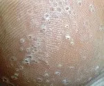 Мелкоточечная кератоліз - причини, симптоми, діагностика та лікування (мелкоточечная) Мелкоточечная кератоліз - причини, симптоми, діагностика та лікування