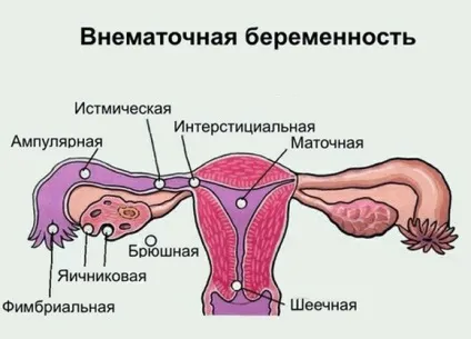 Місячні при вагітності як відрізнити від звичайних (відрізнити) Місячні при вагітності як відрізнити від звичайних